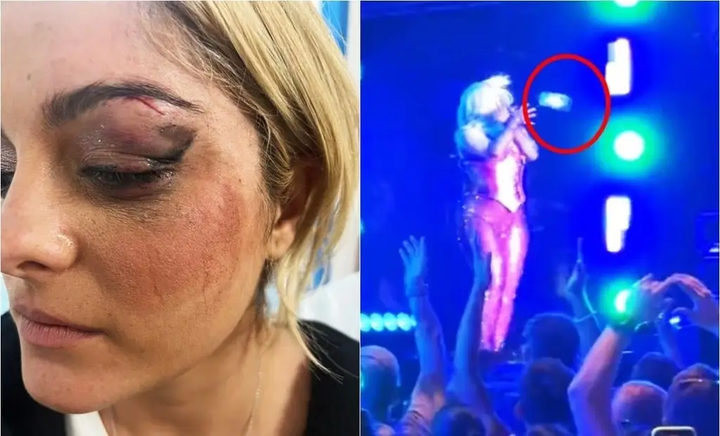 Bebe Rexha fue golpeada con un celular en pleno escenario; así quedó su ojo